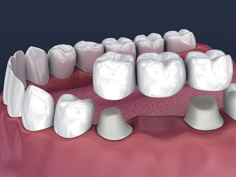 dental bridges in winnipeg