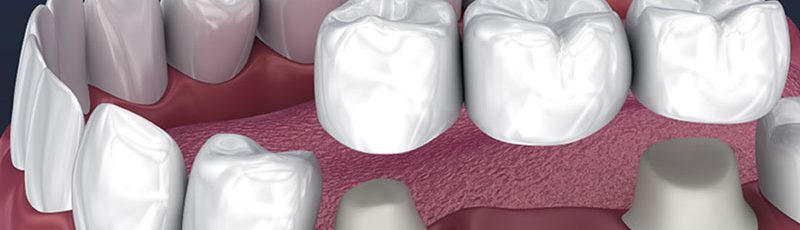 Dental Bridges