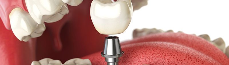 Dental Implants at Garden Oaks Dental Centre