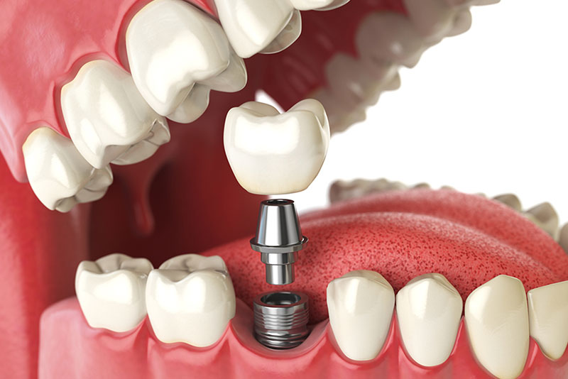 dental implants in winnipeg